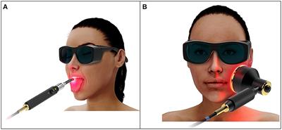 The Path to an Evidence-Based Treatment Protocol for Extraoral Photobiomodulation Therapy for the Prevention of Oral Mucositis